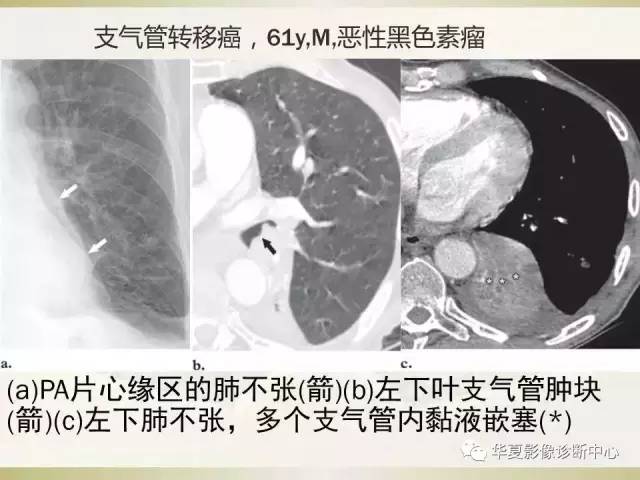 【PPT】指套征——支气管粘液嵌塞征