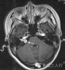 "甜筒冰激凌征"，这个征象提示啥？