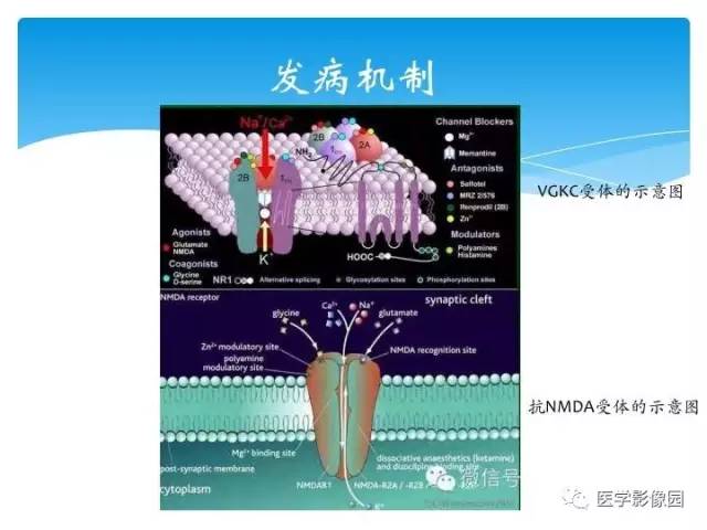 【PPT】儿童免疫性脑炎的临床及MR征象
