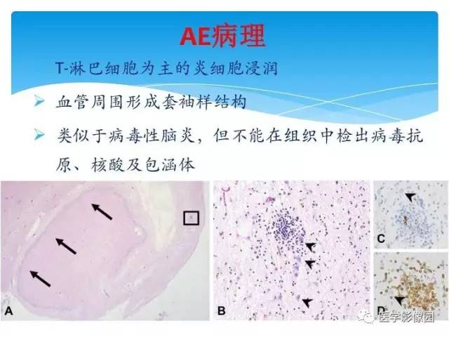 【PPT】儿童免疫性脑炎的临床及MR征象