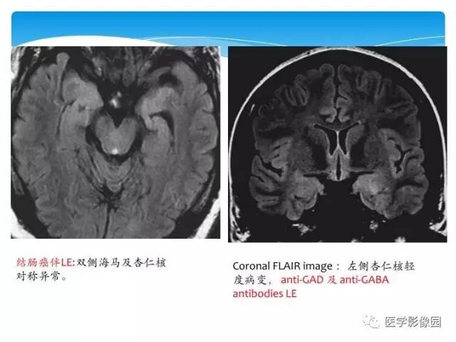 【PPT】儿童免疫性脑炎的临床及MR征象