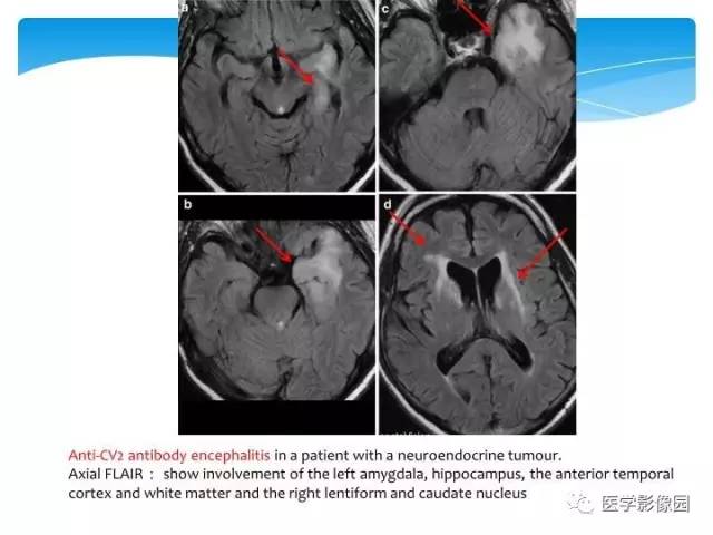 【PPT】儿童免疫性脑炎的临床及MR征象