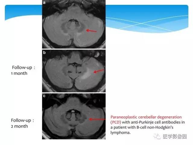 【PPT】儿童免疫性脑炎的临床及MR征象