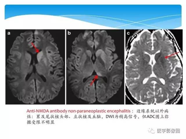 【PPT】儿童免疫性脑炎的临床及MR征象