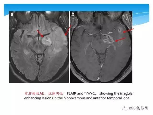 【PPT】儿童免疫性脑炎的临床及MR征象