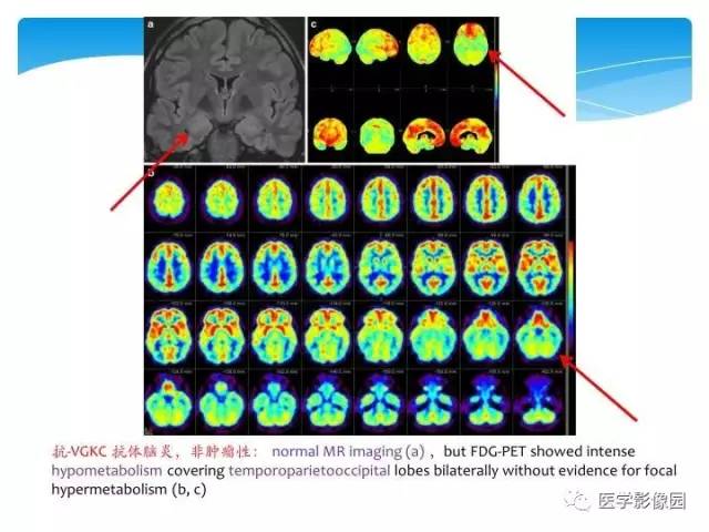 【PPT】儿童免疫性脑炎的临床及MR征象