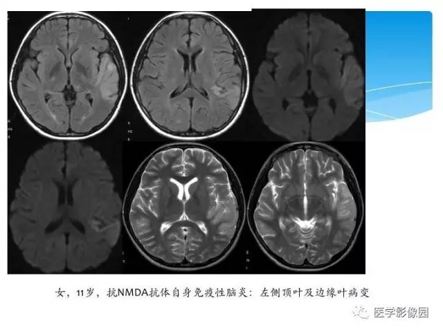 【PPT】儿童免疫性脑炎的临床及MR征象