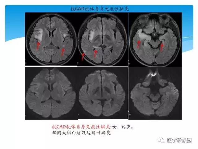 【PPT】儿童免疫性脑炎的临床及MR征象