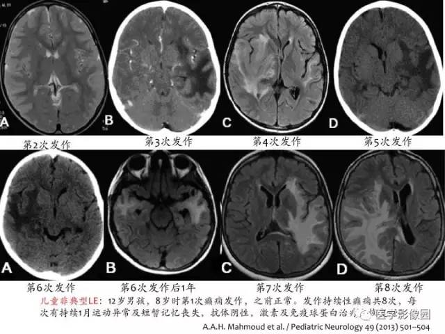 【PPT】儿童免疫性脑炎的临床及MR征象