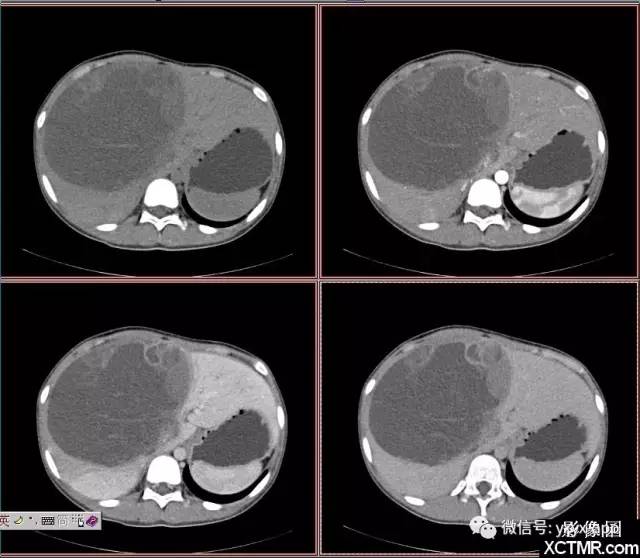 【病例】肝未分化肉瘤1例CT影像表现 【病例】肝未分化肉瘤1例CT影像表现