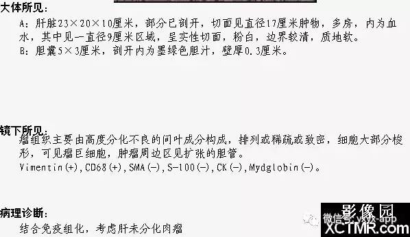 【病例】肝未分化肉瘤1例CT影像表现 【病例】肝未分化肉瘤1例CT影像表现