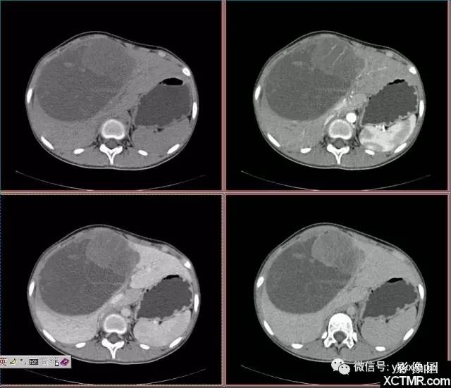【病例】肝未分化肉瘤1例CT影像表现 【病例】肝未分化肉瘤1例CT影像表现