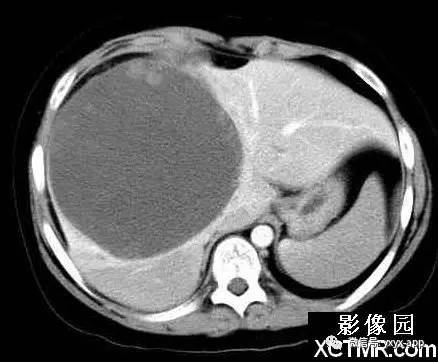 【病例】肝未分化肉瘤1例CT影像表现 【病例】肝未分化肉瘤1例CT影像表现