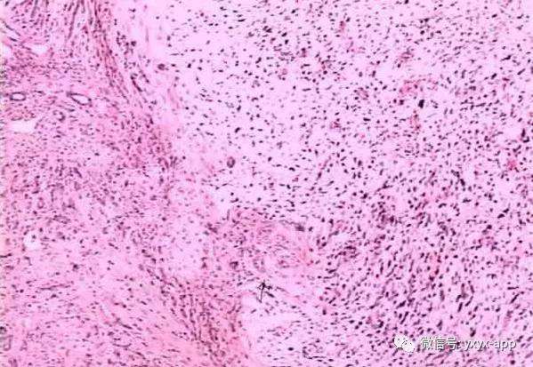 【病例】肝未分化肉瘤1例CT影像表现 【病例】肝未分化肉瘤1例CT影像表现