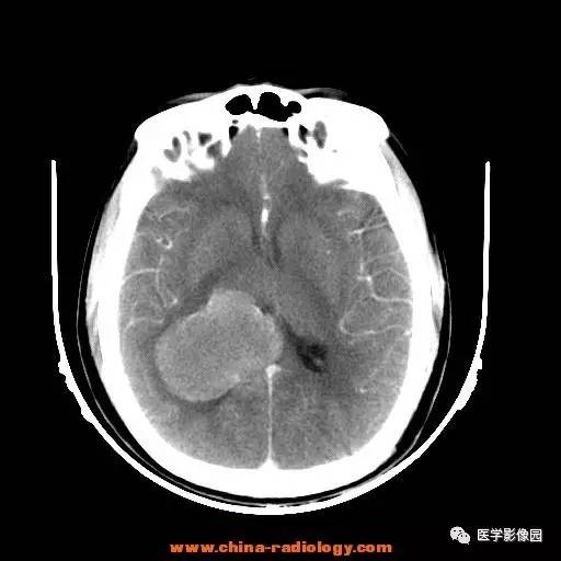 【病例】侧脑室三角区脑膜瘤1例CT及MR影像表现 【病例】侧脑室三角区脑膜瘤1例CT及MR影像表现
