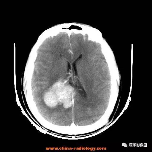 【病例】侧脑室三角区脑膜瘤1例CT及MR影像表现 【病例】侧脑室三角区脑膜瘤1例CT及MR影像表现
