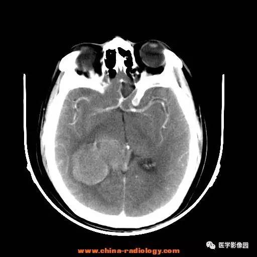 【病例】侧脑室三角区脑膜瘤1例CT及MR影像表现 【病例】侧脑室三角区脑膜瘤1例CT及MR影像表现