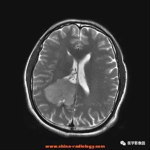 【病例】侧脑室三角区脑膜瘤1例CT及MR影像表现 【病例】侧脑室三角区脑膜瘤1例CT及MR影像表现