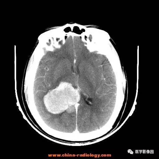 【病例】侧脑室三角区脑膜瘤1例CT及MR影像表现 【病例】侧脑室三角区脑膜瘤1例CT及MR影像表现