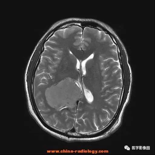 【病例】侧脑室三角区脑膜瘤1例CT及MR影像表现 【病例】侧脑室三角区脑膜瘤1例CT及MR影像表现