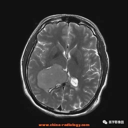 【病例】侧脑室三角区脑膜瘤1例CT及MR影像表现 【病例】侧脑室三角区脑膜瘤1例CT及MR影像表现