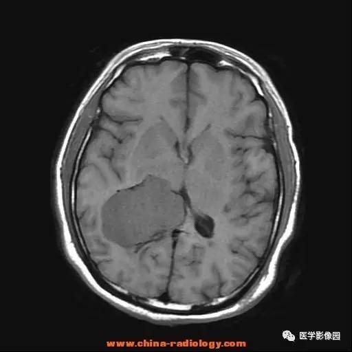 【病例】侧脑室三角区脑膜瘤1例CT及MR影像表现 【病例】侧脑室三角区脑膜瘤1例CT及MR影像表现