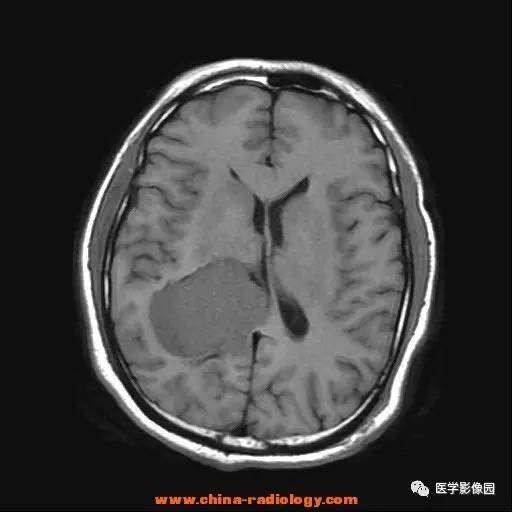 【病例】侧脑室三角区脑膜瘤1例CT及MR影像表现 【病例】侧脑室三角区脑膜瘤1例CT及MR影像表现