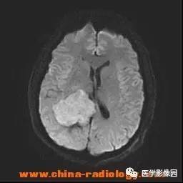 【病例】侧脑室三角区脑膜瘤1例CT及MR影像表现 【病例】侧脑室三角区脑膜瘤1例CT及MR影像表现
