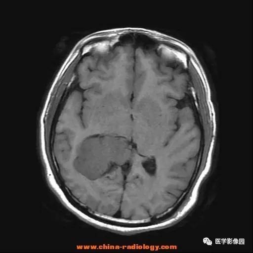【病例】侧脑室三角区脑膜瘤1例CT及MR影像表现 【病例】侧脑室三角区脑膜瘤1例CT及MR影像表现
