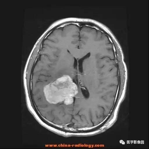 【病例】侧脑室三角区脑膜瘤1例CT及MR影像表现 【病例】侧脑室三角区脑膜瘤1例CT及MR影像表现