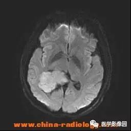 【病例】侧脑室三角区脑膜瘤1例CT及MR影像表现 【病例】侧脑室三角区脑膜瘤1例CT及MR影像表现