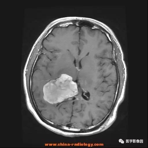 【病例】侧脑室三角区脑膜瘤1例CT及MR影像表现 【病例】侧脑室三角区脑膜瘤1例CT及MR影像表现