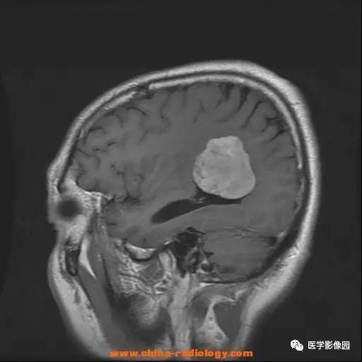【病例】侧脑室三角区脑膜瘤1例CT及MR影像表现 【病例】侧脑室三角区脑膜瘤1例CT及MR影像表现