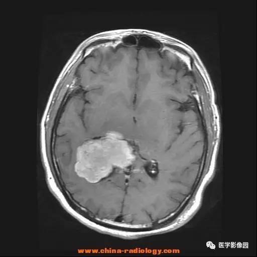 【病例】侧脑室三角区脑膜瘤1例CT及MR影像表现 【病例】侧脑室三角区脑膜瘤1例CT及MR影像表现