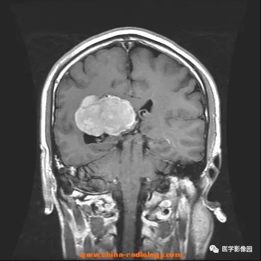 【病例】侧脑室三角区脑膜瘤1例CT及MR影像表现 【病例】侧脑室三角区脑膜瘤1例CT及MR影像表现