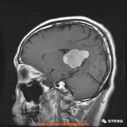 【病例】侧脑室三角区脑膜瘤1例CT及MR影像表现 【病例】侧脑室三角区脑膜瘤1例CT及MR影像表现