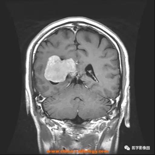 【病例】侧脑室三角区脑膜瘤1例CT及MR影像表现 【病例】侧脑室三角区脑膜瘤1例CT及MR影像表现