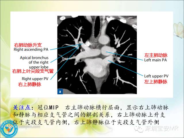 【PPT】肺动、静脉影像断层解剖图解