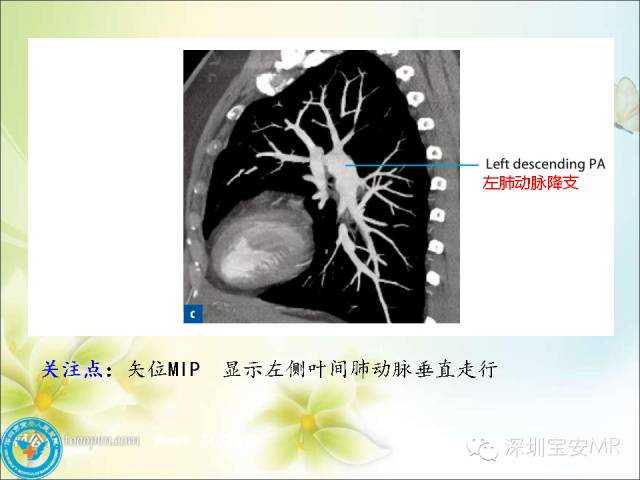 【PPT】肺动、静脉影像断层解剖图解