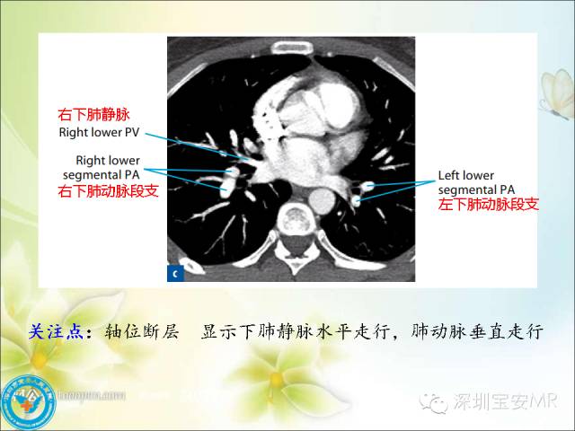 【PPT】肺动、静脉影像断层解剖图解