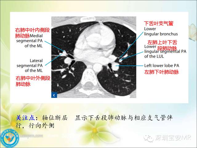 【PPT】肺动、静脉影像断层解剖图解