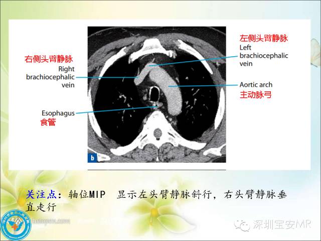 【PPT】肺动、静脉影像断层解剖图解