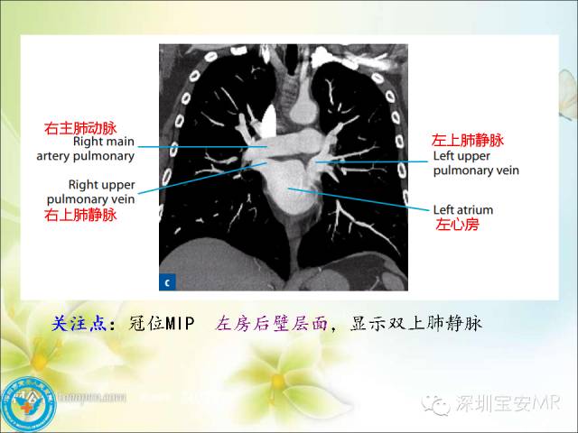 【PPT】肺动、静脉影像断层解剖图解