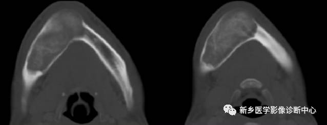 骨的纤维结构不良、 骨性纤维结构不良和骨化性纤维瘤