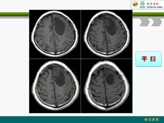 【病例】脑膜瘤VS血管周细胞瘤MR影像表现