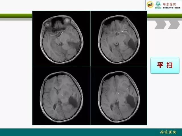 【病例】脑膜瘤VS血管周细胞瘤MR影像表现
