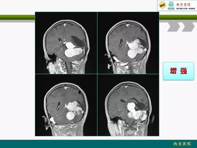 【病例】脑膜瘤VS血管周细胞瘤MR影像表现