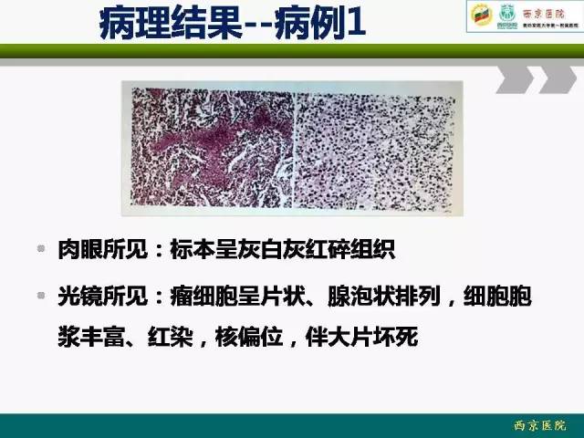 【病例】脑膜瘤VS血管周细胞瘤MR影像表现