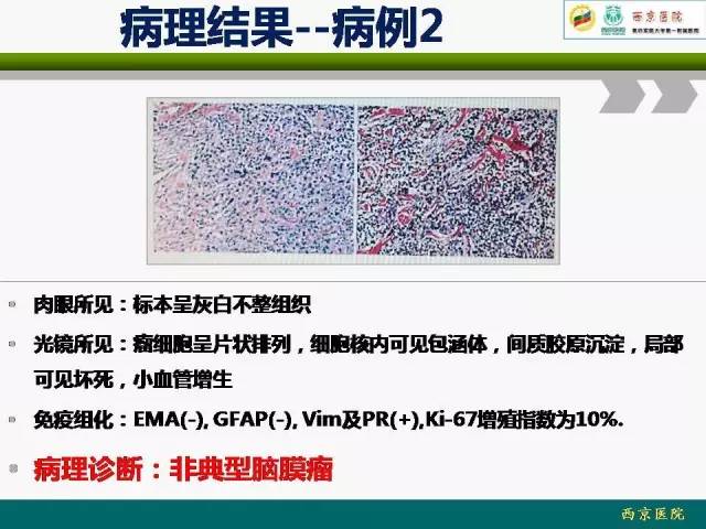 【病例】脑膜瘤VS血管周细胞瘤MR影像表现