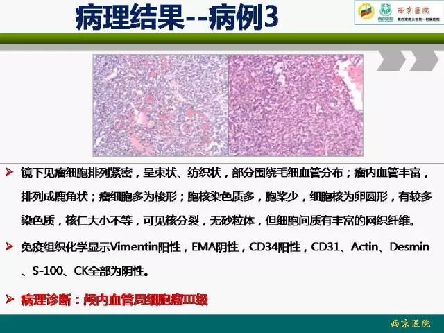 【病例】脑膜瘤VS血管周细胞瘤MR影像表现